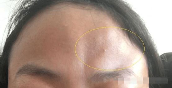 额头有疤痕，不同部位会代表什么事情发生？
